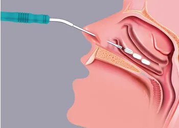 Nasenmuscheln Radiofrequenztherapie